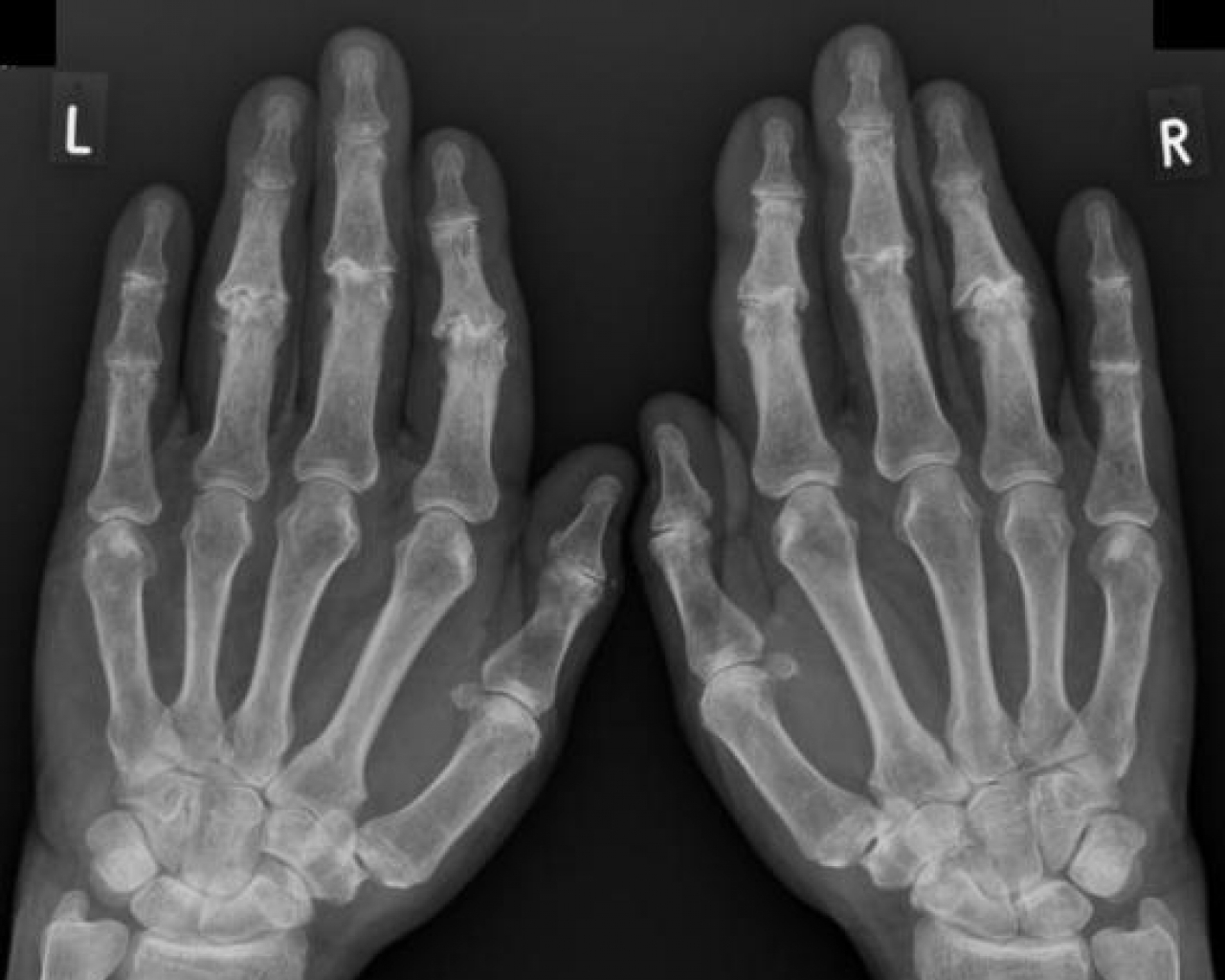 Рентген снимок лучезапястного сустава норма
