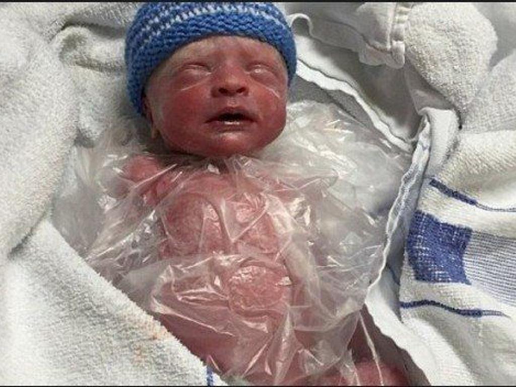 La Bebe De 500 Gramos Que Se Salvo Por Una Bolsa Ziploc Diario El Sol Mendoza Argentina